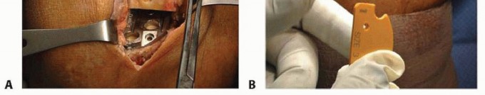 Illustration 17 for Unicondylar Knee Arthroplasty: Is This Your Solution to Knee Pain?