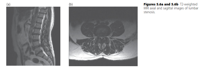 Oral Questions Lumbar: Master Spinal Stenosis & Myelopathy