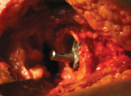 صورة طبية: مفصل الفخذ الصناعي قصير الجذع METHA: حلول مبتكرة للحفاظ على العظم في صنعاء مع الأستاذ الدكتور محمد هطيف