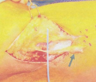 Illustration 55 for Master Diagnosis: Shoulder & Elbow Cases (Reproduced with Permission)