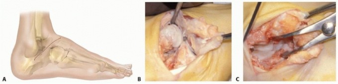 Expert Guide to Triple Arthrodesis et al. for Hindfoot