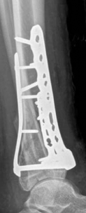 Illustration 25 for Decoding Pilon Fractures: Anterolateral and Medial Fragments Revealed