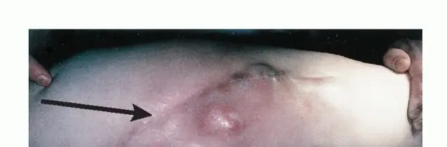 صورة توضيحية لـ استئصال نصف الحوض بالرفرفة الأمامية: حلول متقدمة لأورام الحوض الصعبة مع الأستاذ الدكتور محمد هطيف في صنعاء