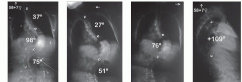 Vertebral Column Resection: Fixing Severe Rigid Spinal Deformity