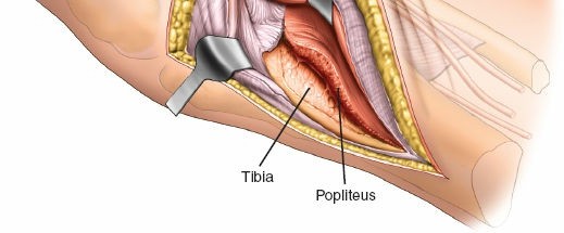 Figure 17: Intraoperative fluoroscopic image showing screw placement in lateral view.