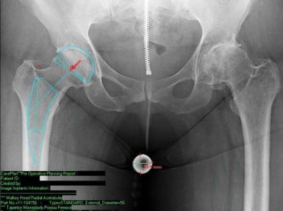 صورة توضيحية لـ تقنية الجذع القصير لاستبدال مفصل الورك الكلي: نهج الأستاذ الدكتور محمد هطيف لتدخل جراحي أقل ونتائج أفضل