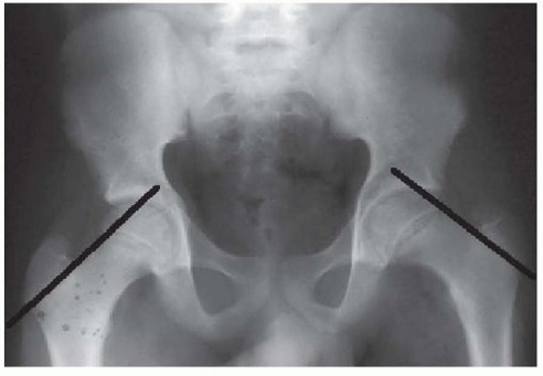 SCFE Fixation: Mastering In Situ Cannulated Screw Techniques