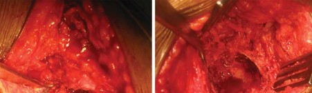 صورة طبية: استبدال مفصل الورك الكلي لالتهاب المفاصل الروماتويدي اليفعي: استعادة الحركة والأمل مع الأستاذ الدكتور محمد هطيف في صنعاء