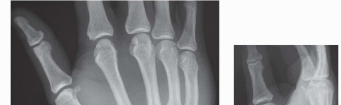 Ring & Small Finger CMC Fractures: Best Operative Treatment to Regain Grip