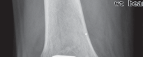Porous Metal Cones: Biologic Fixation for Severe Bone Loss