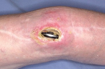 PROSTALAC Articulating Spacer: Treat Infected Knees, Regain Mobility