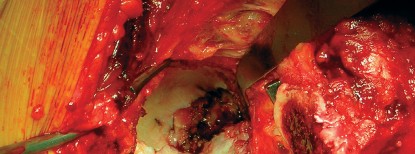 صورة طبية: طول عمر مكون الحُق الأسمنتي في مفصل الورك: مفتاح الاستقرار والديمومة مع الأستاذ الدكتور محمد هطيف في صنعاء