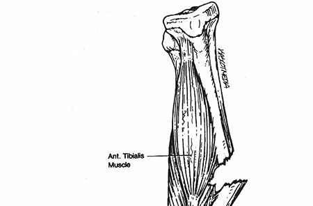 Pediatric Tibia and Fibula Fractures: Essential Clinical Insights