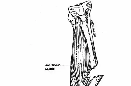 صورة توضيحية لـ كسور عظم الساق (القصبة والشظية) لدى الأطفال: دليل شامل للآباء من الأستاذ الدكتور محمد هطيف