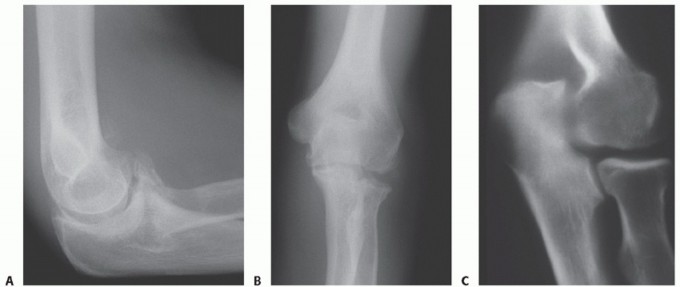 Elbow Pain Relief: Ulnohumeral Outerbridge-Kashiwagi Arthroplasty