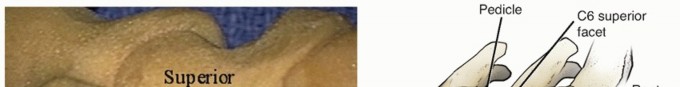 Posterior Cervical Foraminotomy: Relieve Superior Articular Facet Pressure