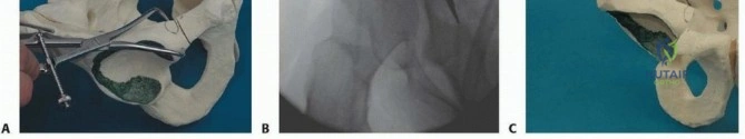 الدليل الشامل لعلاج متلازمة الأشرطة السلوية وجراحة نقل سلاميات أصابع القدم