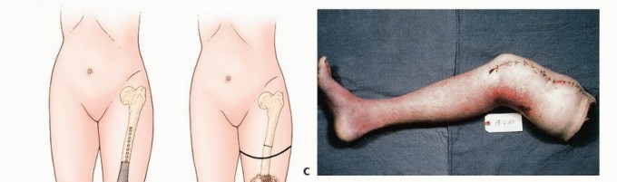 Mastering Above-Knee Amputation: Essential Surgical Insights
