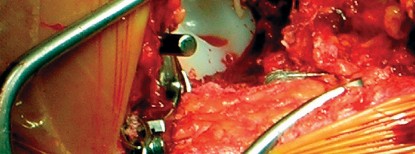 صورة طبية: طول عمر مكون الحُق الأسمنتي في مفصل الورك: مفتاح الاستقرار والديمومة مع الأستاذ الدكتور محمد هطيف في صنعاء