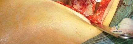صورة طبية: استبدال مفصل الورك بتقنية الحفاظ على عنق الفخذ (CFP): نتائج أولية أفضل ورعاية متقدمة في صنعاء مع الأستاذ الدكتور محمد هطيف