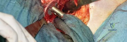 صورة طبية: استبدال مفصل الورك بتقنية الحفاظ على عنق الفخذ (CFP): نتائج أولية أفضل ورعاية متقدمة في صنعاء مع الأستاذ الدكتور محمد هطيف
