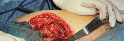 صورة طبية: استبدال مفصل الورك بتقنية الحفاظ على عنق الفخذ (CFP): نتائج أولية أفضل ورعاية متقدمة في صنعاء مع الأستاذ الدكتور محمد هطيف