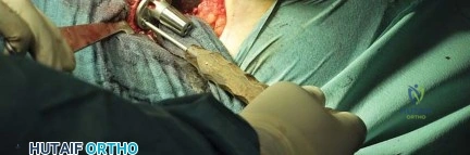 صورة طبية: استبدال مفصل الورك بتقنية الحفاظ على عنق الفخذ (CFP): نتائج أولية أفضل ورعاية متقدمة في صنعاء مع الأستاذ الدكتور محمد هطيف