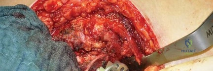صورة طبية: استبدال مفصل الورك بتقنية الحفاظ على عنق الفخذ (CFP): نتائج أولية أفضل ورعاية متقدمة في صنعاء مع الأستاذ الدكتور محمد هطيف