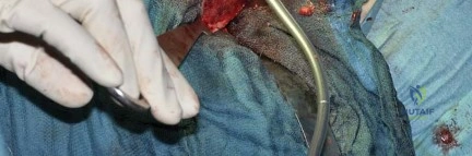 صورة طبية: استبدال مفصل الورك بتقنية الحفاظ على عنق الفخذ (CFP): نتائج أولية أفضل ورعاية متقدمة في صنعاء مع الأستاذ الدكتور محمد هطيف