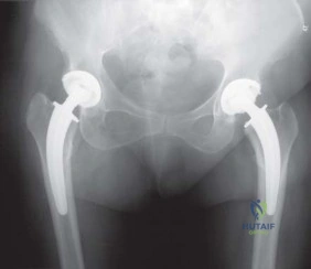 صورة طبية: استبدال مفصل الورك بتقنية الحفاظ على عنق الفخذ (CFP): نتائج أولية أفضل ورعاية متقدمة في صنعاء مع الأستاذ الدكتور محمد هطيف
