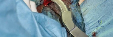 صورة طبية: استبدال مفصل الورك بتقنية الحفاظ على عنق الفخذ (CFP): نتائج أولية أفضل ورعاية متقدمة في صنعاء مع الأستاذ الدكتور محمد هطيف