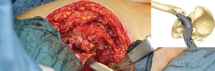 صورة طبية: استبدال مفصل الورك بتقنية الحفاظ على عنق الفخذ (CFP): نتائج أولية أفضل ورعاية متقدمة في صنعاء مع الأستاذ الدكتور محمد هطيف