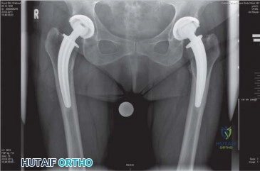 صورة طبية: استبدال مفصل الورك بتقنية الحفاظ على عنق الفخذ (CFP): نتائج أولية أفضل ورعاية متقدمة في صنعاء مع الأستاذ الدكتور محمد هطيف