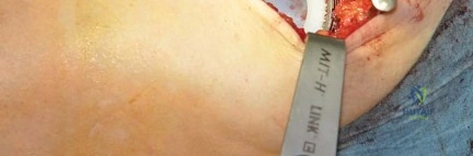 صورة طبية: استبدال مفصل الورك بتقنية الحفاظ على عنق الفخذ (CFP): نتائج أولية أفضل ورعاية متقدمة في صنعاء مع الأستاذ الدكتور محمد هطيف