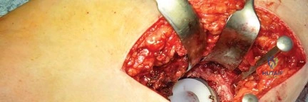 صورة طبية: استبدال مفصل الورك بتقنية الحفاظ على عنق الفخذ (CFP): نتائج أولية أفضل ورعاية متقدمة في صنعاء مع الأستاذ الدكتور محمد هطيف