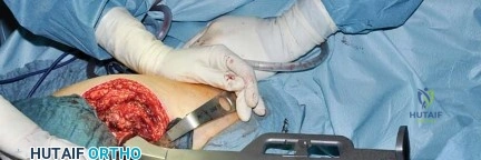 صورة طبية: استبدال مفصل الورك بتقنية الحفاظ على عنق الفخذ (CFP): نتائج أولية أفضل ورعاية متقدمة في صنعاء مع الأستاذ الدكتور محمد هطيف