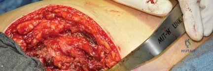 صورة طبية: استبدال مفصل الورك بتقنية الحفاظ على عنق الفخذ (CFP): نتائج أولية أفضل ورعاية متقدمة في صنعاء مع الأستاذ الدكتور محمد هطيف