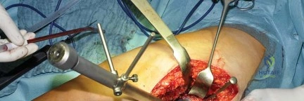 صورة طبية: استبدال مفصل الورك بتقنية الحفاظ على عنق الفخذ (CFP): نتائج أولية أفضل ورعاية متقدمة في صنعاء مع الأستاذ الدكتور محمد هطيف