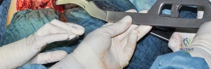صورة طبية: استبدال مفصل الورك بتقنية الحفاظ على عنق الفخذ (CFP): نتائج أولية أفضل ورعاية متقدمة في صنعاء مع الأستاذ الدكتور محمد هطيف