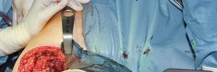 صورة طبية: استبدال مفصل الورك بتقنية الحفاظ على عنق الفخذ (CFP): نتائج أولية أفضل ورعاية متقدمة في صنعاء مع الأستاذ الدكتور محمد هطيف