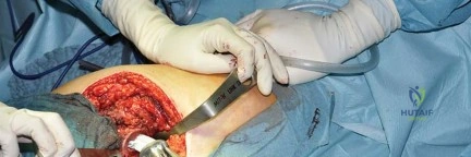 صورة طبية: استبدال مفصل الورك بتقنية الحفاظ على عنق الفخذ (CFP): نتائج أولية أفضل ورعاية متقدمة في صنعاء مع الأستاذ الدكتور محمد هطيف
