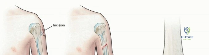 Correction of Radial Neck Malunion: The Modified Inhofe and Moneim Technique