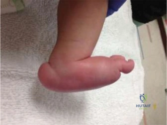 Illustration of congenital vertical talus - Dr. Mohammed Hutaif
