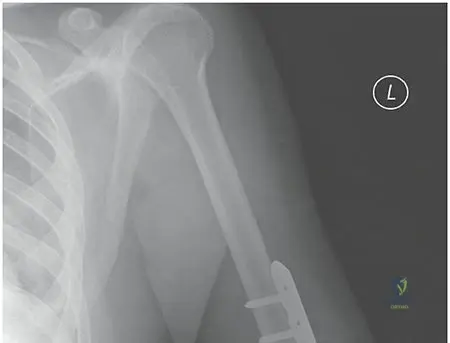 Humeral Shaft Fractures: Expert Insights on Diagnosis & Treatment