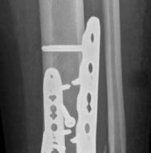Illustration 23 for Decoding Pilon Fractures: Anterolateral and Medial Fragments Revealed