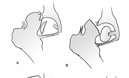 Illustration of femoral head fracture - Dr. Mohammed Hutaif