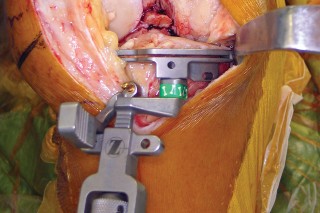Illustration 14 for Minimize Pain, Maximize Recovery: TKA with Parapatellar