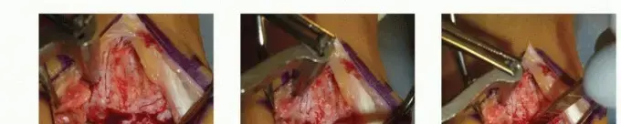 صورة توضيحية لـ علاج آلام الكاحل المستعصية: دليل شامل لإصابات الغضروف والعظم في عظم الكاحل (OLT) وزراعة الغضاريف اليافعة المجزأة