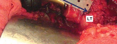 Illustration 13 for Mastering Soft Tissue Balancing for Optimal THR Outcomes