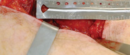 Illustration 30 for Unlock the Figure Posterior Approach to the Hip